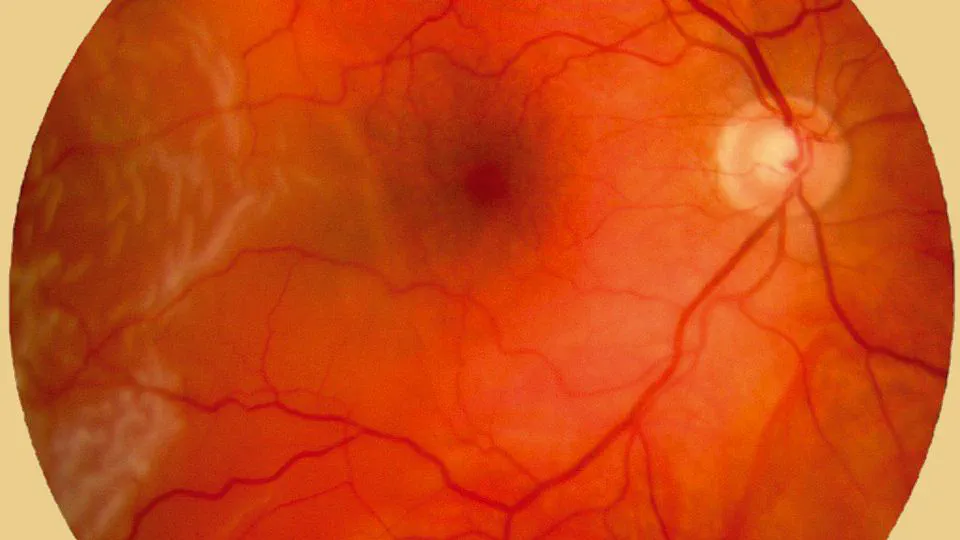 Systemic Fluoroquinolone Use and Risk of Uveitis or Retinal Detachment