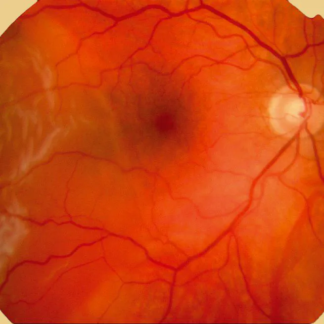 Systemic Fluoroquinolone Use and Risk of Uveitis or Retinal Detachment